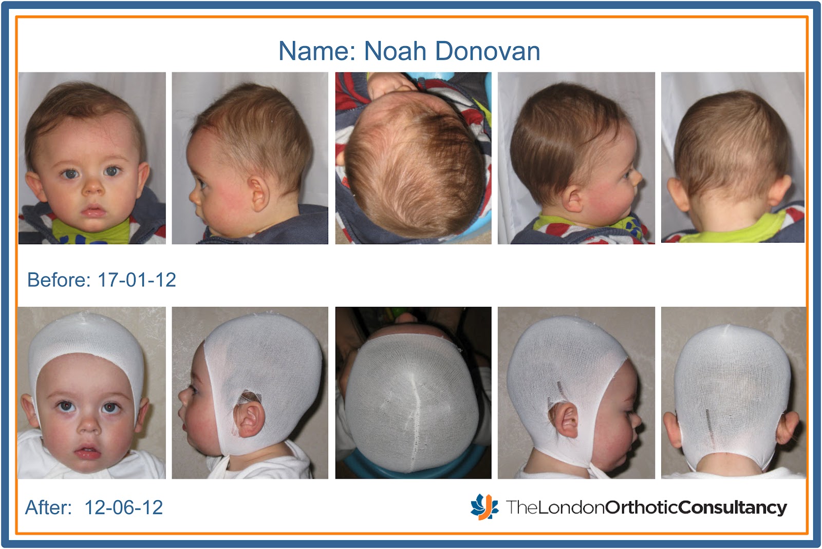 sudocrem before and after sudocrem before and after